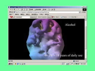 Alcohol
44 y/o -- 18 years of daily use
 