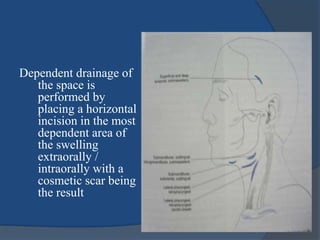 Dependent drainage of
the space is
performed by
placing a horizontal
incision in the most
dependent area of
the swelling
extraorally /
intraorally with a
cosmetic scar being
the result
 