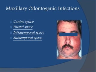 Maxillary Odontogenic Infections
 Canine space
 Palatal space
 Infratemporal space
 Subtemporal space
 