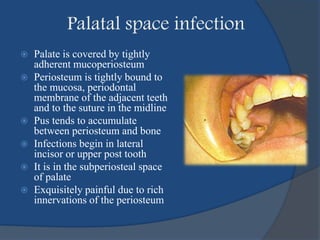  Palate is covered by tightly
adherent mucoperiosteum
 Periosteum is tightly bound to
the mucosa, periodontal
membrane of the adjacent teeth
and to the suture in the midline
 Pus tends to accumulate
between periosteum and bone
 Infections begin in lateral
incisor or upper post tooth
 It is in the subperiosteal space
of palate
 Exquisitely painful due to rich
innervations of the periosteum
Palatal space infection
 