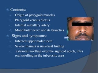  Contents:
a. Origin of pterygoid muscles
b. Pterygoid venous plexus
c. Internal maxillary artery
d. Mandibular nerve and its branches
 Signs and symptoms:
a. Infected upper molar teeth
b. Severe trismus is universal finding
c. extraoral swelling over the sigmoid notch, intra
oral swelling in the tuberosity area
 