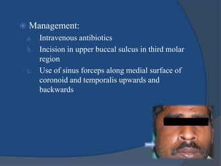  Management:
a. Intravenous antibiotics
b. Incision in upper buccal sulcus in third molar
region
c. Use of sinus forceps along medial surface of
coronoid and temporalis upwards and
backwards
 