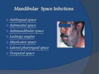 Mandibular Space Infections
 Sublingual space
 Submental space
 Submandibular space
 Ludwigs angina
 Masticator space
 Lateral pharyngeal space
 Temporal space
 
