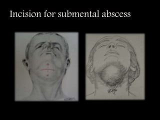 Incision for submental abscess
 