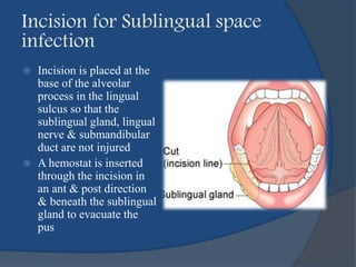  Incision is placed at the
base of the alveolar
process in the lingual
sulcus so that the
sublingual gland, lingual
nerve & submandibular
duct are not injured
 A hemostat is inserted
through the incision in
an ant & post direction
& beneath the sublingual
gland to evacuate the
pus
Incision for Sublingual space
infection
 