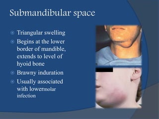 Submandibular space
 Triangular swelling
 Begins at the lower
border of mandible,
extends to level of
hyoid bone
 Brawny induration
 Usually associated
with lowermolar
infection
 