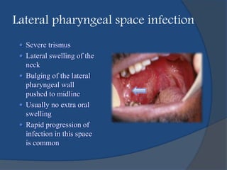  Severe trismus
 Lateral swelling of the
neck
 Bulging of the lateral
pharyngeal wall
pushed to midline
 Usually no extra oral
swelling
 Rapid progression of
infection in this space
is common
Lateral pharyngeal space infection
 