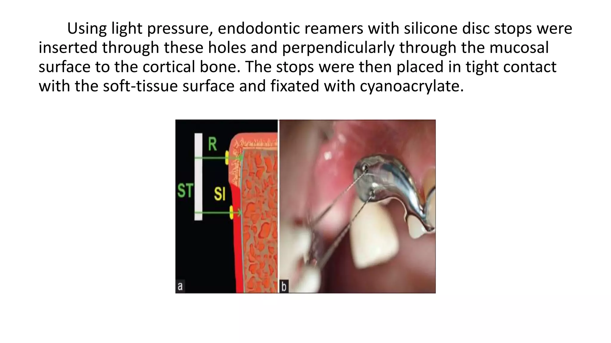 Using light pressure, endodontic reamers with silicone disc stops were
inserted through these holes and perpendicularly through the mucosal
surface to the cortical bone. The stops were then placed in tight contact
with the soft-tissue surface and fixated with cyanoacrylate.
 