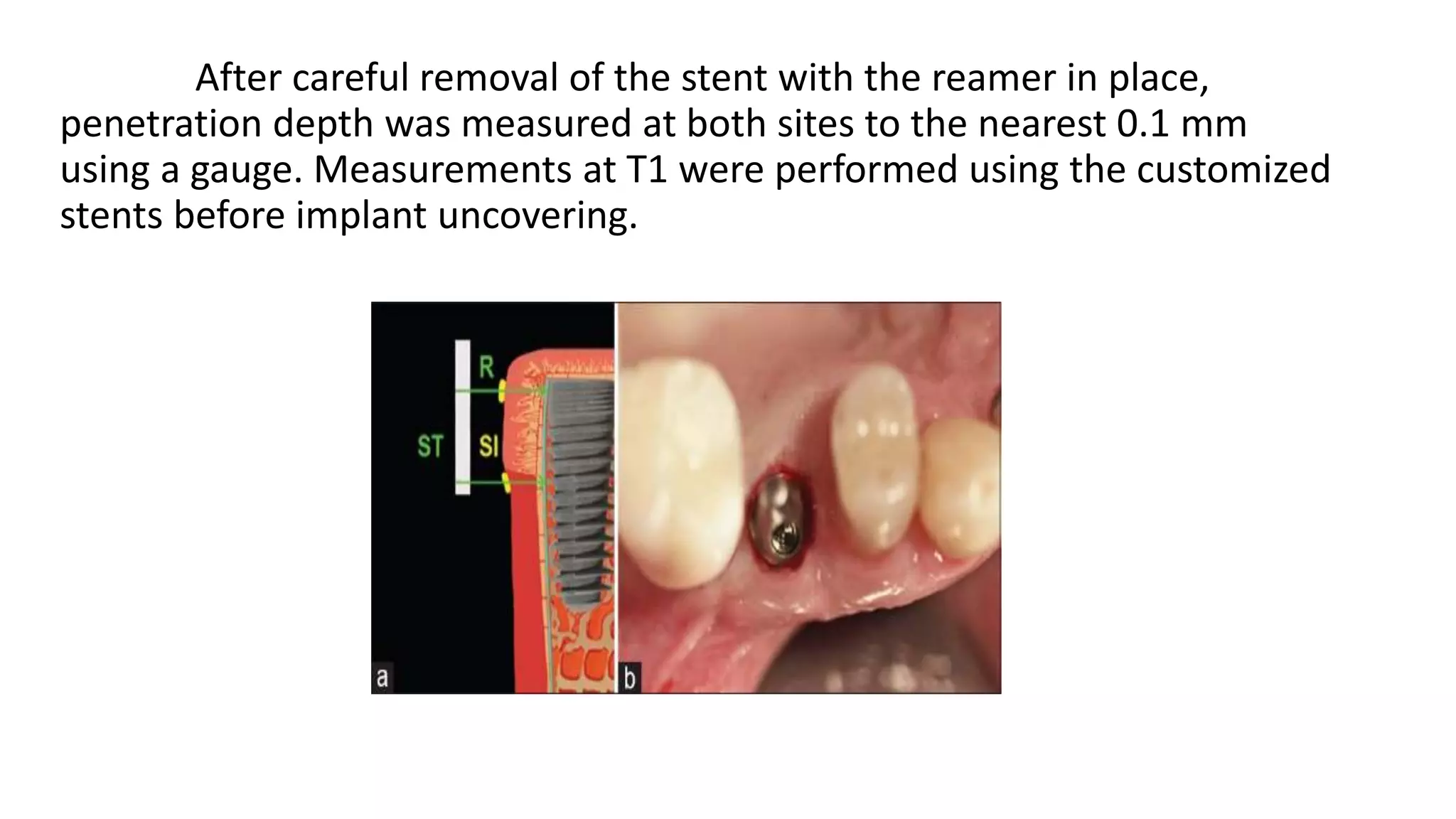 After careful removal of the stent with the reamer in place,
penetration depth was measured at both sites to the nearest 0.1 mm
using a gauge. Measurements at T1 were performed using the customized
stents before implant uncovering.
 