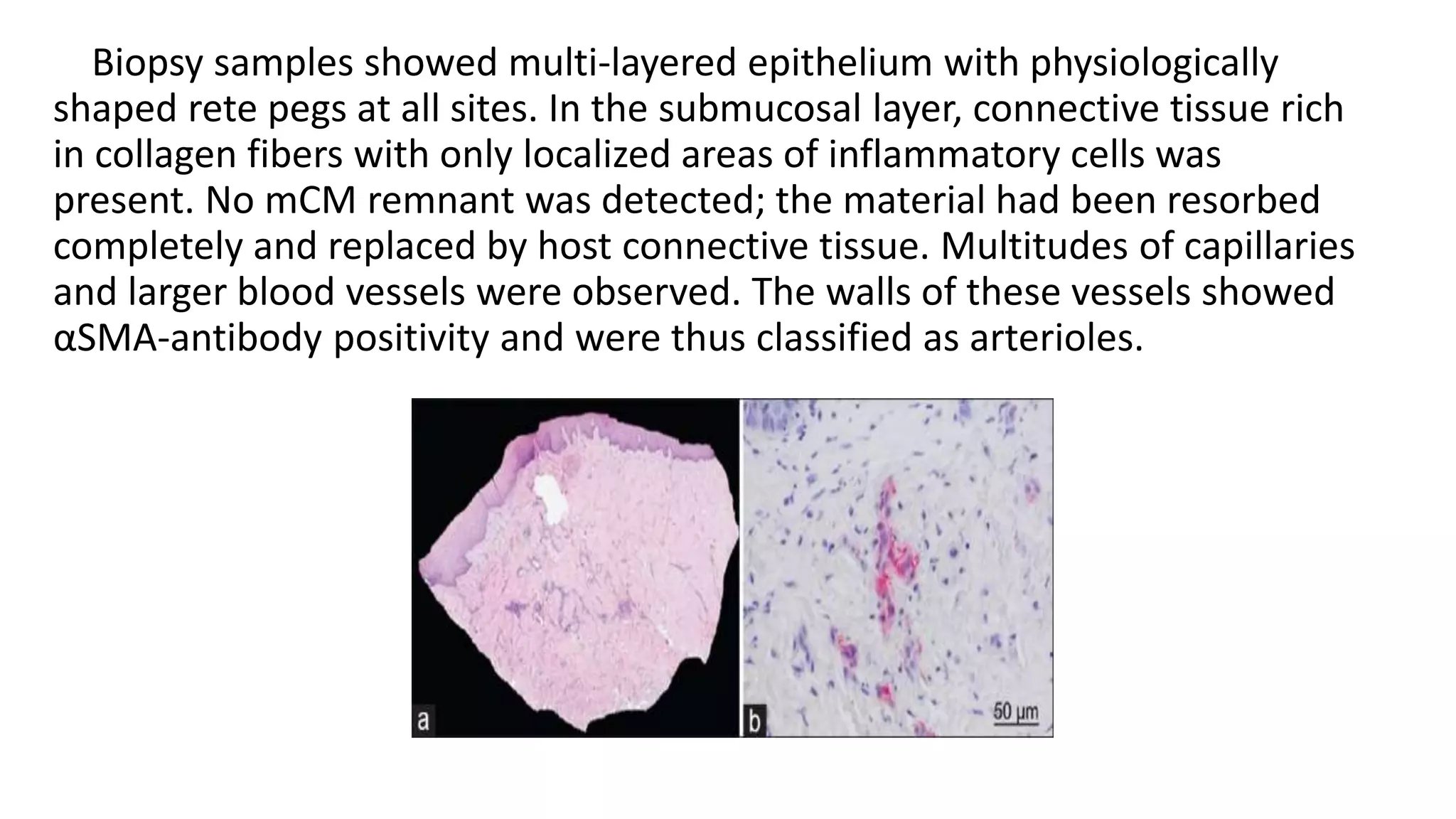 Biopsy samples showed multi-layered epithelium with physiologically
shaped rete pegs at all sites. In the submucosal layer, connective tissue rich
in collagen fibers with only localized areas of inflammatory cells was
present. No mCM remnant was detected; the material had been resorbed
completely and replaced by host connective tissue. Multitudes of capillaries
and larger blood vessels were observed. The walls of these vessels showed
αSMA-antibody positivity and were thus classified as arterioles.
 