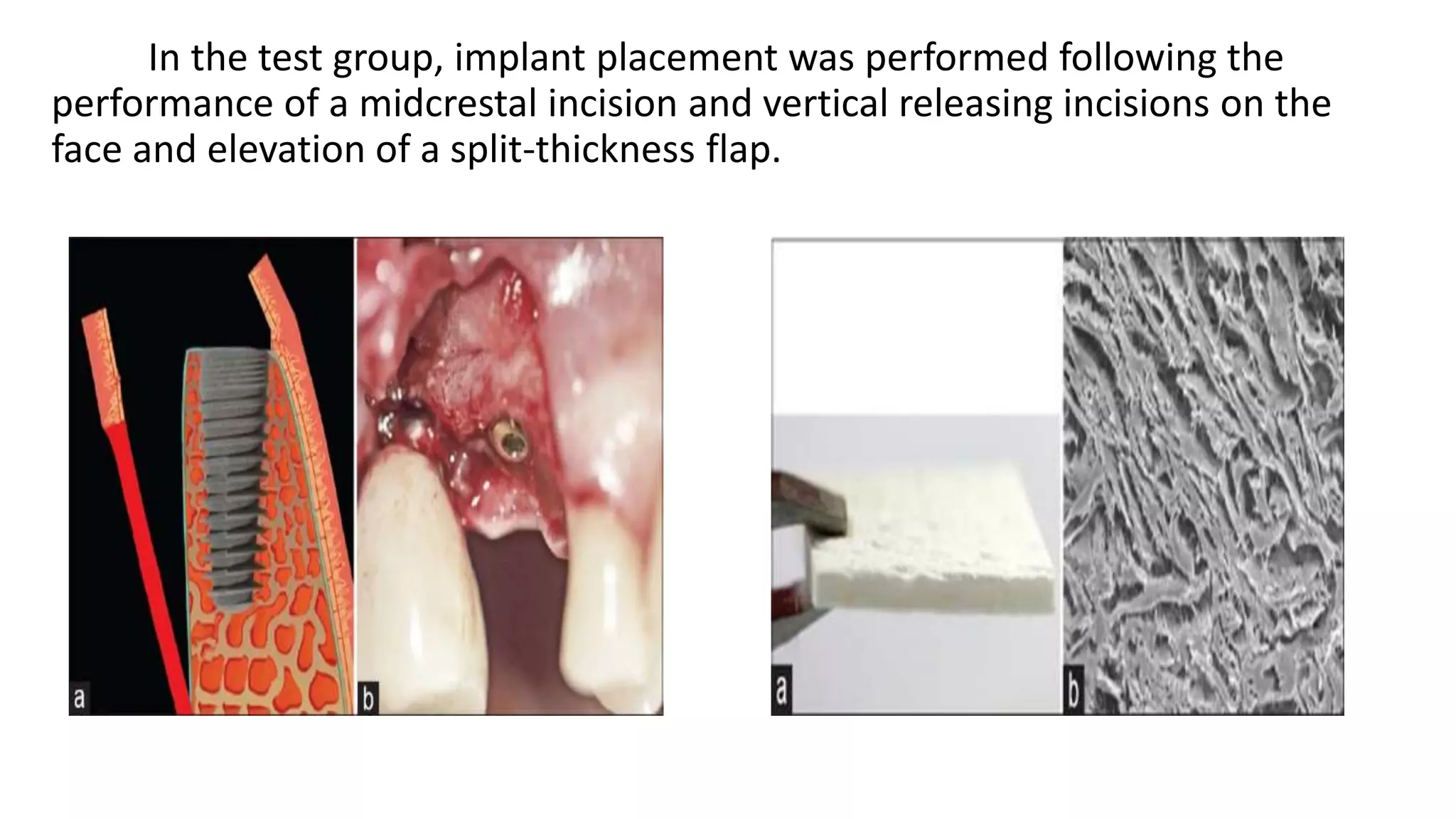 In the test group, implant placement was performed following the
performance of a midcrestal incision and vertical releasing incisions on the
face and elevation of a split-thickness flap.
 