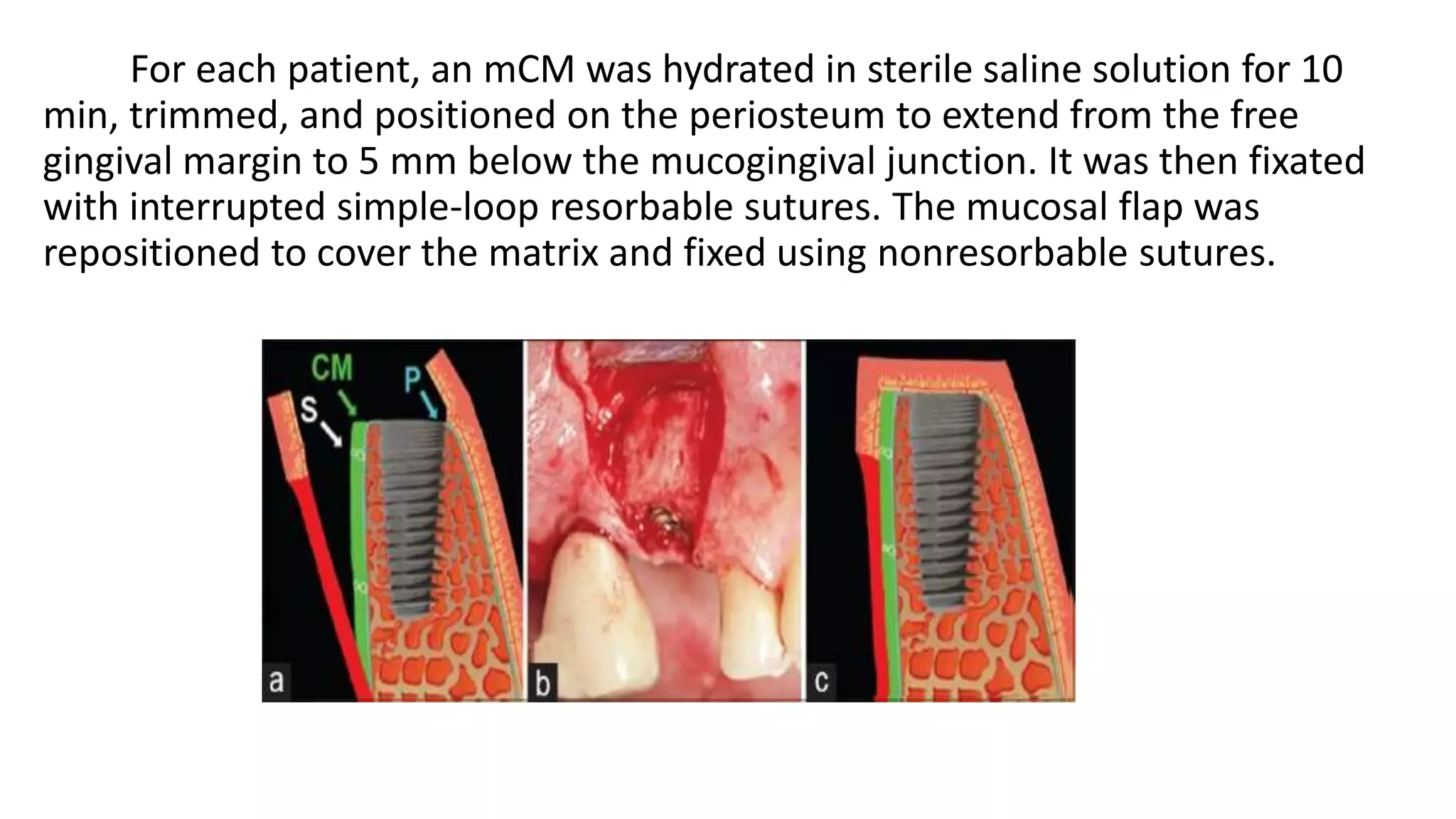 For each patient, an mCM was hydrated in sterile saline solution for 10
min, trimmed, and positioned on the periosteum to extend from the free
gingival margin to 5 mm below the mucogingival junction. It was then fixated
with interrupted simple-loop resorbable sutures. The mucosal flap was
repositioned to cover the matrix and fixed using nonresorbable sutures.
 
