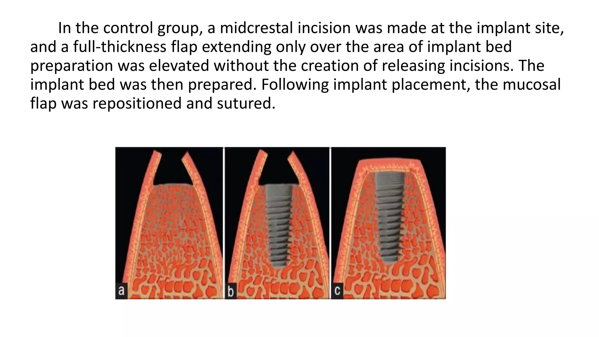 In the control group, a midcrestal incision was made at the implant site,
and a full-thickness flap extending only over the area of implant bed
preparation was elevated without the creation of releasing incisions. The
implant bed was then prepared. Following implant placement, the mucosal
flap was repositioned and sutured.
 