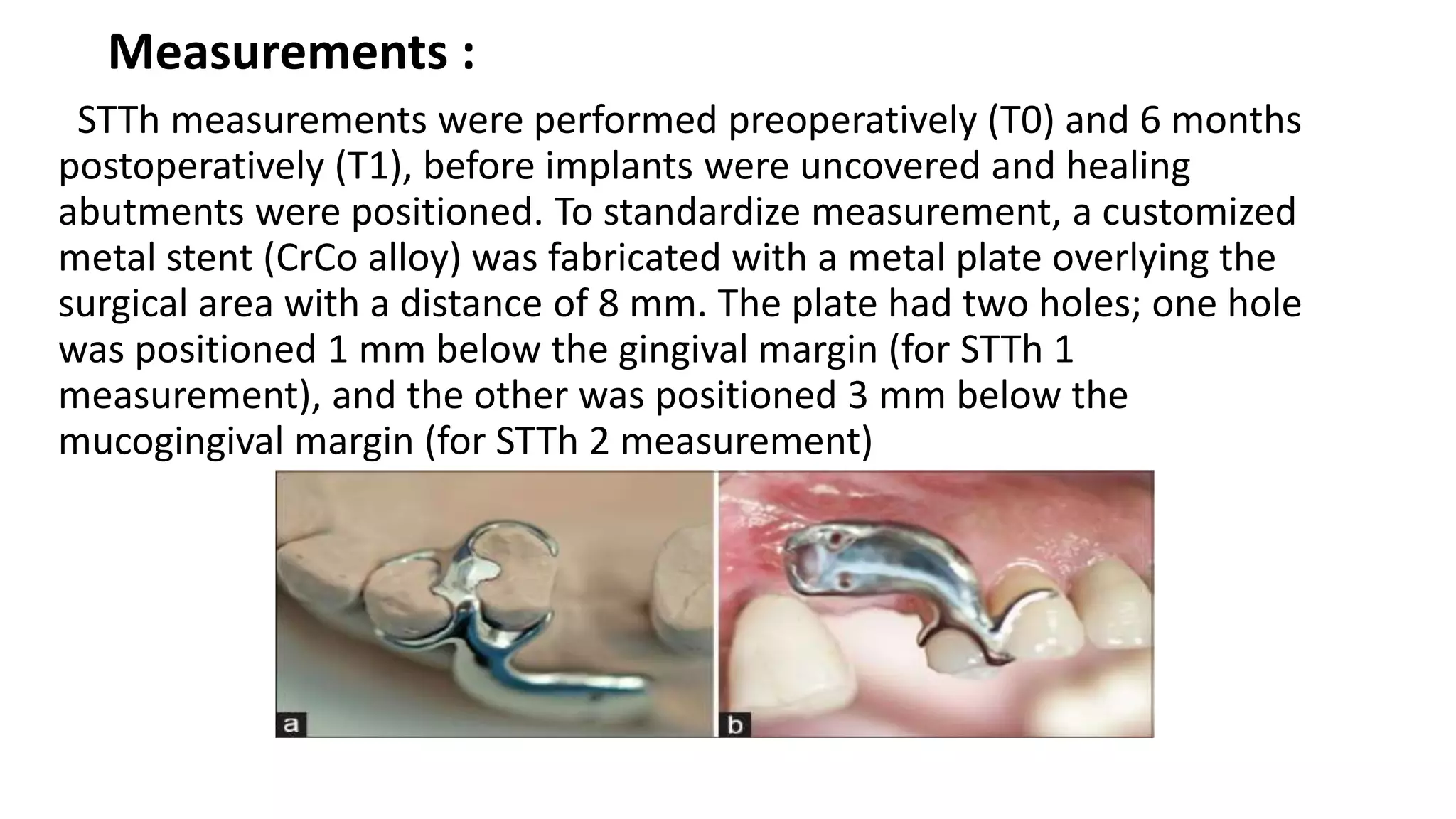 Measurements :
STTh measurements were performed preoperatively (T0) and 6 months
postoperatively (T1), before implants were uncovered and healing
abutments were positioned. To standardize measurement, a customized
metal stent (CrCo alloy) was fabricated with a metal plate overlying the
surgical area with a distance of 8 mm. The plate had two holes; one hole
was positioned 1 mm below the gingival margin (for STTh 1
measurement), and the other was positioned 3 mm below the
mucogingival margin (for STTh 2 measurement)
 