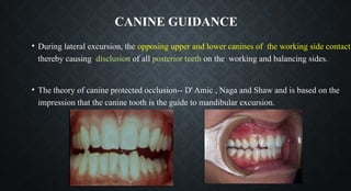 CANINE GUIDANCE
• During lateral excursion, the opposing upper and lower canines of the working side contact
thereby causing disclusion of all posterior teeth on the working and balancing sides.
• The theory of canine protected occlusion-- D' Amic , Naga and Shaw and is based on the
impression that the canine tooth is the guide to mandibular excursion.
 