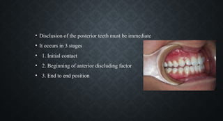• Disclusion of the posterior teeth must be immediate
• It occurs in 3 stages
• 1. Initial contact
• 2. Beginning of anterior discluding factor
• 3. End to end position
 
