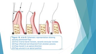 Apical Direction CHAN JOHN PERIO.pptx periodontal flap ppt | PPTX
