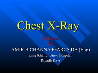 Chest X-Ray   Collection By AMIR B.CHANNA FFARCS,DA (Eng) King Khalid  Univ. Hospital  Riyadh KSA 