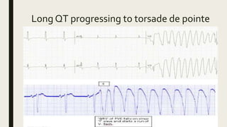 Long QT progressing to torsade de pointe
 
