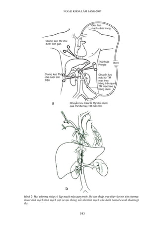 NGOẠI KHOA LÂM SÀNG-2007
Hình 2- Hai phương pháp cô lập mạch máu gan trước khi can thiệp trực tiếp vào nơi tổn thương:
shunt tĩnh mạch-tĩnh mạch (a) và tạo thông nối nhĩ-tĩnh mạch chủ dưới (atrial-caval shunting)
(b).
543
 