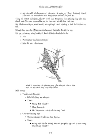 NGOẠI KHOA LÂM SÀNG-2007
o Mở rộng chỗ vỡ (hepatotomy) bằng đầu các ngón tay (finger fracture), tìm và
kiểm soát các nhánh mạch máu đang chảy ở đáy chỗ vỡ (hình 4).
Trong bất cứ tình huống nào, nếu BN có rối loạn đông máu, chọn phương pháp cầm máu
nhanh nhất. Nếu máu ngưng chảy sau khi chèn gạc, nên kết thúc cuộc mổ.
Đặt dẫn lưu (dưới gan, dưới hoành) nếu nghi ngờ có dò mật hay tụ dịch dưới hoành sau
mổ.
Nếu có chèn gạc, cho BN cephazolin 1gm mỗi 8 giờ cho đến khi rút gạc.
Rút gạc chèn trong vòng 24-48 giờ. Trước khi rút cần chuẩn bị sẵn:
o Máu
o Phương tiện truyền máu tự thân
o Máy đốt laser bằng Argon
Hình 4- Một trong các phương pháp cầm máu gan: tìm và kiểm
soát các mạch máu đang chảy ở đáy chỗ vỡ
Biến chứng:
o Tụ dịch mật (biloma):
Biểu hiện bằng sốt, vàng da.
Xử trí:
Khẳng định bằng CT
Chọc dò qua da
ERCP đặt stent và/hoặc cắt cơ vòng Oddi.
o Chảy máu đường mật:
Thường xảy ra 2-4 tuần sau chấn thương.
Xử trí:
Khẳng định có tổn thương nhu mô gan phức tạp/khối tụ dịch trong
nhu mô gan bằng CT
545
 