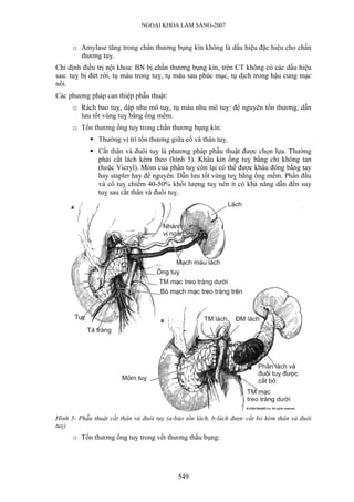 NGOẠI KHOA LÂM SÀNG-2007
o Amylase tăng trong chấn thương bụng kín không là dấu hiệu đặc hiệu cho chấn
thương tuỵ.
Chỉ định điều trị nội khoa: BN bị chấn thương bụng kín, trên CT không có các dấu hiệu
sau: tuỵ bị đứt rời, tụ máu trong tuỵ, tụ máu sau phúc mạc, tụ dịch trong hậu cung mạc
nối.
Các phương pháp can thiệp phẫu thuật:
o Rách bao tuỵ, dập nhu mô tuỵ, tụ máu nhu mô tuỵ: để nguyên tổn thương, dẫn
lưu tốt vùng tuỵ bằng ống mềm.
o Tổn thương ống tuỵ trong chấn thương bụng kín:
Thường vị trí tổn thương giữa cổ và thân tuỵ.
Cắt thân và đuôi tuỵ là phương pháp phẫu thuật được chọn lựa. Thường
phải cắt lách kèm theo (hình 5). Khâu kín ống tuỵ bằng chỉ không tan
(hoặc Vicryl). Mỏm của phần tuỵ còn lại có thể được khâu đóng bằng tay
hay stapler hay để nguyên. Dẫn lưu tốt vùng tuỵ bằng ống mềm. Phần đầu
và cổ tuỵ chiếm 40-50% khối lượng tuỵ nên ít có khả năng dẫn đến suy
tuỵ sau cắt thân và đuôi tuỵ.
Hình 5- Phẫu thuật cắt thân và đuôi tuỵ (a-bảo tồn lách, b-lách được cắt bỏ kèm thân và đuôi
tuỵ)
o Tổn thương ống tuỵ trong vết thương thấu bụng:
549
 