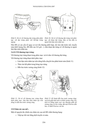 NGOẠI KHOA LÂM SÀNG-2007
Hình 9- Xử trí vết thương đại tràng phải phức
tạp: cắt đại tràng phải, nối hồi-đại tràng
ngang
Hình 10- Xử trí vết thương đại tràng trái phức
tạp: cắt đoạn đại tràng, đưa cả hai đầu ra
ngoài làm hậu môn nhân tạo
Nếu BN có các yếu tố nguy cơ (có tổn thương phối hợp, sốc kéo dài trước mổ, truyền
máu khối lượng lớn, BN đến sau 4-6 giờ…): đưa đoạn đại tràng có vết thương ra ngoài
làm hậu môn nhân tạo.
3.4.11-Vết thương trực tràng:
Vết thương trực tràng đoạn trong phúc mạc: xử trí như vết thương đại tràng.
Vết thương trực tràng đoạn dưới phúc mạc:
o Làm hậu môn nhân tạo trên dòng kiểu chuyển lưu phân hoàn toàn (hình 11)
o Tháo rửa hết phân trong bóng trực tràng
o Dẫn lưu trước xương cùng (hình 12)
Hình 11- Xử trí vết thương trực tràng đoạn
dưới phúc mạc: làm hậu môn nhân tạo trên
dòng và dẫn lưu trước xương cùng.
Hình 12- Kỹ thuật dẫn lưu trước xương cùng:
rạch da giữa hậu môn và đỉnh xương cùng, bóc
tách tù (bằng ngón tay) vào khoang giữa hố
xương cùng và trực tràng, đặt một Penrose dẫn
lưu, cố định Penrose vào da.
3.5-Chăm sóc sau mổ ;
Một số nguyên tắc chính của chăm sóc sau mổ BN chấn thương bụng:
o Tiếp tục hồi sức bằng dịch truyền và máu.
554
 