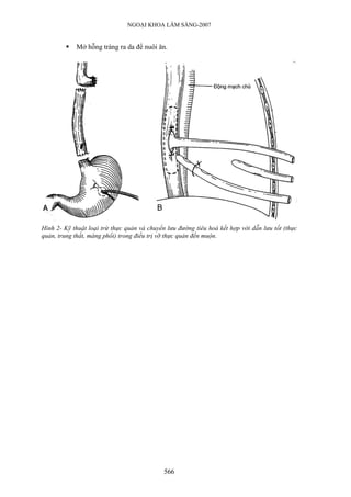 NGOẠI KHOA LÂM SÀNG-2007
Mở hỗng tràng ra da để nuôi ăn.
Hình 2- Kỹ thuật loại trừ thực quản và chuyển lưu đường tiêu hoá kết hợp với dẫn lưu tốt (thực
quản, trung thất, màng phổi) trong điều trị vỡ thực quản đến muộn.
566
 