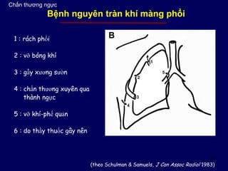 12
1 : rách phổi
2 : vỡ bóng khí
3 : gẫy xương sườn
4 : chấn thương xuyên qua
thành ngực
5 : vỡ khí-phế quản
6 : do thầy thuốc gây nên
(theo Schulman & Samuels, J Can Assoc Radiol 1983)
Chấn thương ngực
Bệnh nguyên tràn khí màng phổi
 