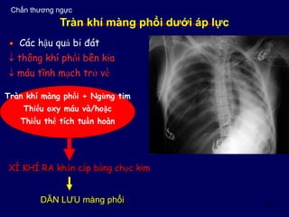 13
Tràn khí màng phổi + Ngừng tim
Thiếu oxy máu và/hoặc
Thiếu thể tích tuần hoàn
XÌ KHÍ RA khẩn cấp bằng chọc kim
Các hậu quả bi đát :
 thông khí phổi bên kia
 máu tĩnh mạch trở về
Chấn thương ngực
Tràn khí màng phổi dưới áp lực
DẪN LƯU màng phổi
 