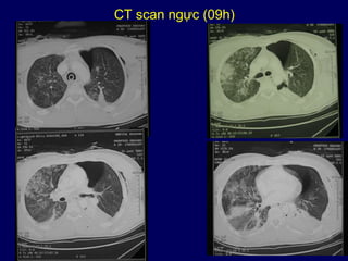 17
CT scan ngực (09h)
 