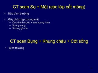 19
CT scan Sọ + Mặt (các lớp cắt mỏng)
• Não bình thường
• Gãy phức tạp xương mặt
– Các thành trước + sau xoang hàm
– Xoang sàng
– Xương gò má
CT scan Bụng + Khung chậu + Cột sống
• Bình thường
 