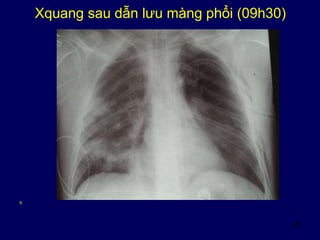 20
Xquang sau dẫn lưu màng phổi (09h30)
b
 