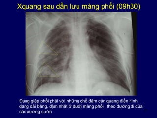 21
Xquang sau dẫn lưu màng phổi (09h30)
Đụng giập phổi phải với những chỗ đậm cản quang điển hình
dạng dải băng, đậm nhất ở dưới màng phổi , theo đường đi của
các xương sườn
 