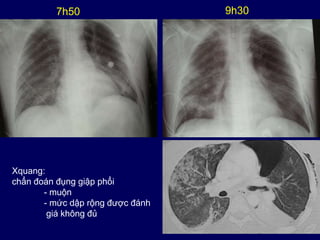 22
7h50 9h30
Xquang:
chẩn đoán đụng giập phổi
- muộn
- mức dập rộng được đánh
giá không đủ
 