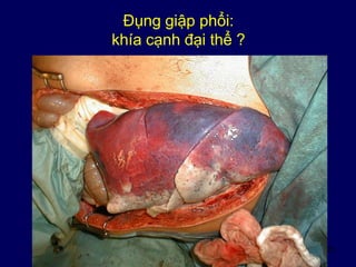 25
Đụng giập phổi:
khía cạnh đại thể ?
 