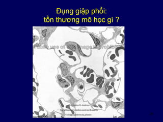 26
Đụng giập phổi:
tổn thương mô học gì ?
 
