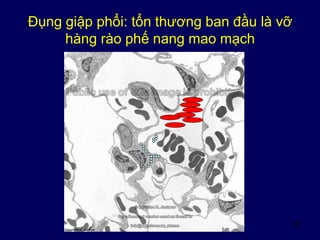 28
Đụng giập phổi: tổn thương ban đầu là vỡ
hàng rào phế nang mao mạch
 