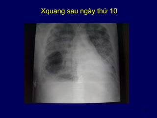 53
Xquang sau ngày thứ 10
 