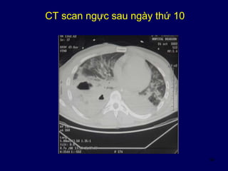 54
CT scan ngực sau ngày thứ 10
 