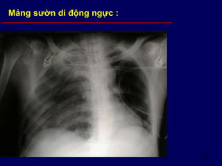 58
Mảng sườn di động ngực :
 