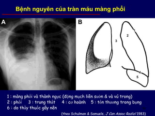 59
1 : màng phổi và thành ngực (động mạch liên sườn & và vú trong)
2 : phổi 3 : trung thất 4 : cơ hoành 5 : tổn thương trong bụng
6 : do thầy thuốc gây nên
(theo Schulman & Samuels, J Can Assoc Radiol 1983)
Bệnh nguyên của tràn máu màng phổi
 