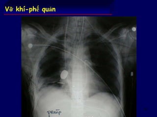 63
Vỡ khí-phế quản
 