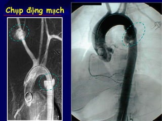 72
Chụp động mạch
 