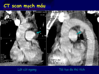 73
CT scan mạch máu
Lát cắt ngang Tái tạo đa thể tích
 