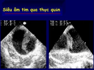 74
Siêu âm tim qua thực quản
 