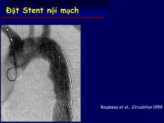 77
Đặt Stent nội mạch
Rousseau et al., Circulation 1999
 