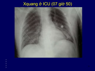 8
Xquang ở ICU (07 giờ 50)
•
•
•
•
•
 