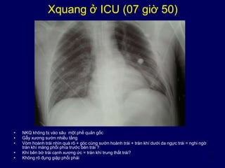 9
Xquang ở ICU (07 giờ 50)
• NKQ không bị vào sâu một phế quản gốc
• Gẫy xương sườn nhiều tầng
• Vòm hoành trái nhìn quá rõ + góc cùng sườn hoành trái + tràn khí dưới da ngực trái = nghi ngờ
tràn khí màng phổi phía trước bên trái ?
• Khí bên bờ trái cạnh xương ức = tràn khí trung thất trái?
• Không rõ đụng giập phổi phải
 