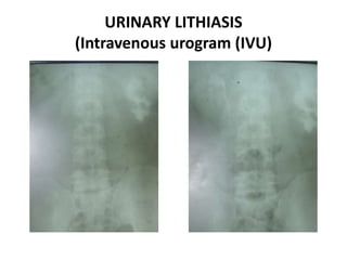 URINARY LITHIASIS
(Intravenous urogram (IVU)
 